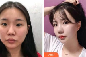 保定珍潤(rùn)醫(yī)療美容門診部劉軍整形價(jià)格表附眼部綜合案例展示