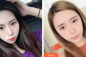 保定葉美思醫(yī)療美容診所劉雙立整形價(jià)格表附自體脂肪豐面頰案例展示