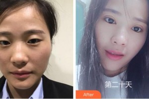 保定新視眼科醫(yī)院熊寧整形價(jià)格表附切開雙眼皮案例展示