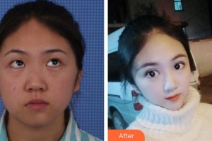 保定新視眼科醫(yī)院唐俊鳳整形價(jià)格表附切開雙眼皮案例展示