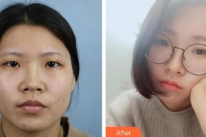 保定藍(lán)山醫(yī)療美容醫(yī)院尹延喜整形價(jià)格表附切開雙眼皮案例展示