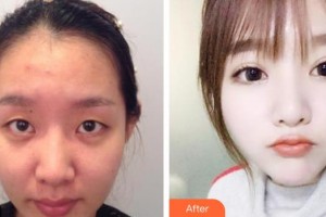 保定新視眼科醫(yī)院劉富奎整形價(jià)格表附眼部綜合案例展示