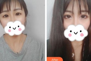 保定新視眼科醫(yī)院李金堂整形價(jià)格表附眼部綜合案例展示