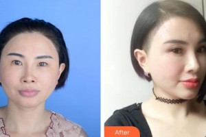 保定新視眼科醫(yī)院王穎整形價(jià)格表附切開雙眼皮案例展示