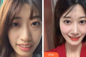 中山大學(xué)附屬口腔醫(yī)院楊小平整形價格表附牙齒矯正案例展示