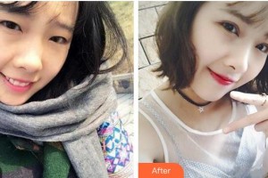 保定新視眼科醫(yī)院申文輝整形價(jià)格表附切開雙眼皮案例展示