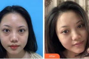 保定新視眼科醫(yī)院李月平整形價(jià)格表附內(nèi)切祛眼袋案例展示