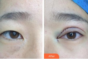 保定新視眼科醫(yī)院楊紅志整形價(jià)格表附眼部綜合案例展示