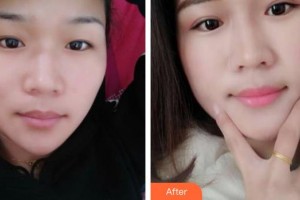 保定悅美醫(yī)療美容門診部整形價(jià)格表附埋線雙眼皮案例展示