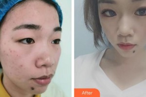 保定藍(lán)山醫(yī)療美容醫(yī)院于超整形價格表附定點雙眼皮案例展示