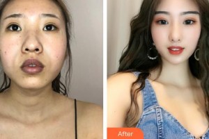 保定藍(lán)山醫(yī)療美容醫(yī)院張揚(yáng)整形價格表附埋線提升案例展示