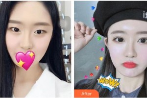 保定悅美醫(yī)療美容門診部孟令申整形價(jià)格表附切開雙眼皮案例展示