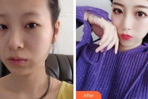 保定藍(lán)山醫(yī)療美容醫(yī)院張素芬整形價格表附埋線提升案例展示