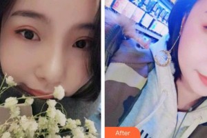 保定東陽口腔醫(yī)院王增光整形價格表附牙齒隱形矯正案例展示