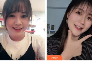 保定市口腔醫(yī)院金永強(qiáng)整形價格表附金屬托槽矯正案例展示