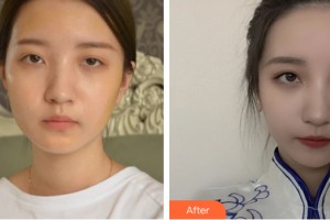 哈爾濱美聯(lián)致美整形醫(yī)院張斗烈整形價格表附自體脂肪填充案例展示