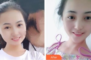 張家口維多利亞醫(yī)療美容醫(yī)院張凱整形價格表附耳軟骨復(fù)合隆鼻案例展示