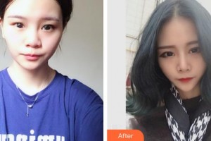 張家口維多利亞醫(yī)療美容醫(yī)院王亞勇整形價格表附鼻部綜合案例展示