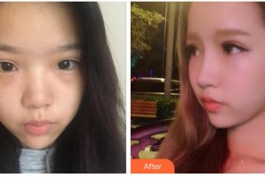 張家口維多利亞醫(yī)療美容醫(yī)院武成利整形價格表附鼻部綜合案例展示