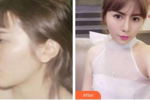 張家口維多利亞醫(yī)療美容醫(yī)院邱榮強(qiáng)整形價格表附鼻部綜合案例展示