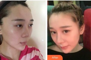 張家口維多利亞醫(yī)療美容醫(yī)院李成輝整形價格表附鼻部綜合案例展示