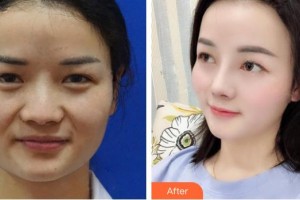 張家口維多利亞醫(yī)療美容醫(yī)院薛華棟整形價(jià)格表附肋軟骨隆鼻案例展示