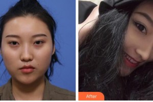 張家口維美醫(yī)療美容醫(yī)院姜濤整形價格表附埋線提升案例展示