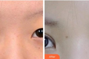 承德名媛醫(yī)療美容門診部崔春曉整形價(jià)格表附眼部綜合案例展示