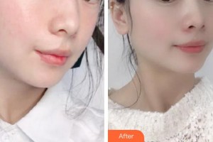 承德玥萊美醫(yī)療美容醫(yī)院齊顯龍整形價(jià)格表附激光美膚激光案例展示