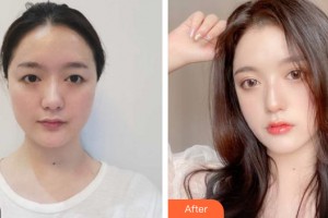 哈爾濱麗珍醫(yī)療美容醫(yī)院金祐正整形價格表附眼部手術(shù)案例展示