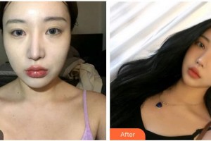 承德愛爾眼科醫(yī)院劉毅坤整形價(jià)格表附內(nèi)切祛眼袋案例展示