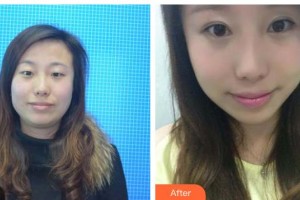 承德愛爾眼科醫(yī)院孟麗梅整形價(jià)格表附眼部綜合案例展示