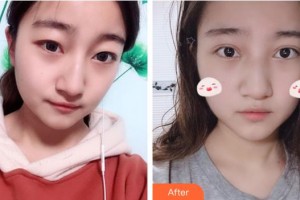 承德愛爾眼科醫(yī)院蘇暢整形價(jià)格表附眼部綜合案例展示