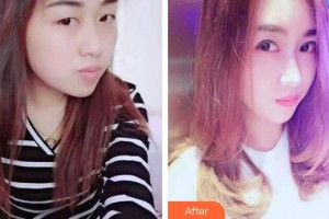 承德朝聚眼科醫(yī)院張鐵民整形價(jià)格表附切開雙眼皮案例展示