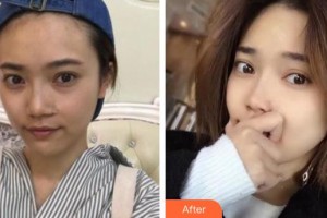 承德玥萊美醫(yī)療美容醫(yī)院楊鵬整形價(jià)格表附切開雙眼皮案例展示