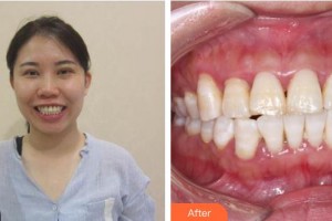 承德愛爾眼科醫(yī)院王明月整形價(jià)格表附牙齒隱形矯正案例展示