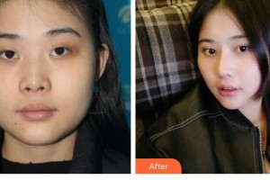 滄州靜港醫(yī)療美容診所鄭祥奎整形價(jià)格表附鼻部綜合案例展示