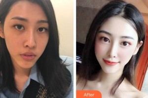 滄州奧拉克醫(yī)療美容醫(yī)院樸根范整形價(jià)格表附鼻部綜合案例展示