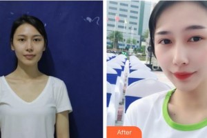 滄州楓華醫(yī)療美容診所羅偉整形價(jià)格表附鼻部綜合案例展示