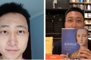 滄州奧拉克醫(yī)療美容醫(yī)院龍始恩整形價(jià)格表附種眉毛案例展示