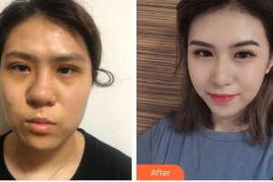 滄州瑞美醫(yī)療美容門診部牛永敢整形價(jià)格表附假體隆鼻案例展示