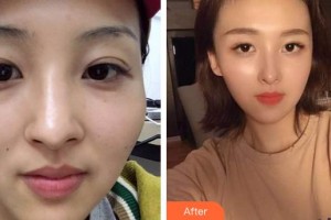 滄州華美醫(yī)療美容醫(yī)院陳遠(yuǎn)琨整形價(jià)格表附鼻部綜合案例展示