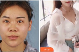 滄州市人民醫(yī)院燒傷整形科高瑩整形價(jià)格表附肋軟骨隆鼻案例展示