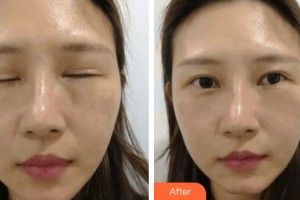 滄州眼科醫(yī)院賈洪強(qiáng)整形價(jià)格表附內(nèi)切祛眼袋案例展示