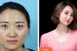 滄州眼科醫(yī)院周暢達(dá)整形價(jià)格表附切開雙眼皮案例展示