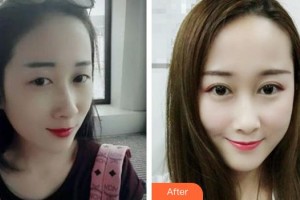 滄州眼科醫(yī)院韓二杰整形價(jià)格表附切開雙眼皮案例展示