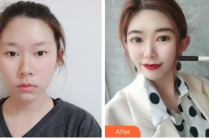 滄州華美醫(yī)療美容醫(yī)院張超院長整形價格表附埋線雙眼皮案例展示