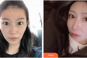 滄州眼科醫(yī)院路露整形價格表附眼部綜合案例展示