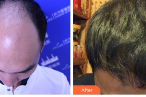 廊坊華康醫(yī)療美容門診部董海英整形價(jià)格表附頭頂加密種植案例展示