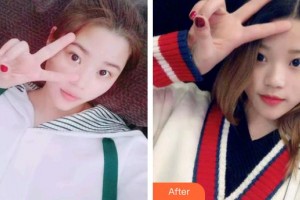 廊坊凱潤婷（原悅美）醫(yī)療美容門診部張誠整形價格表附切開雙眼皮案例展示